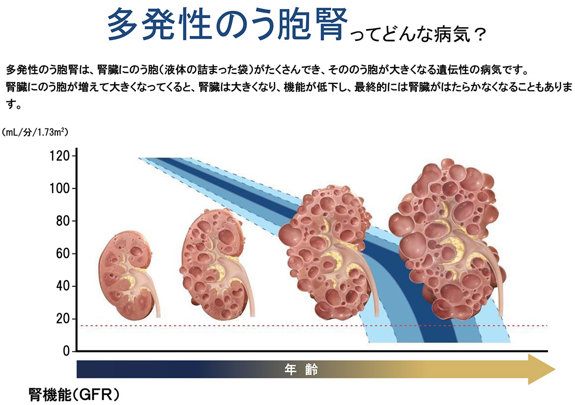 多発性のう胞腎ってどんな病気？