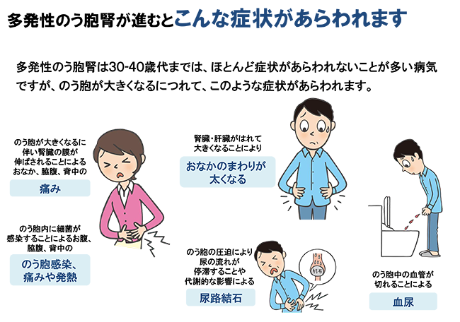 多発性のう胞腎が進むとこんな症状があらわれます