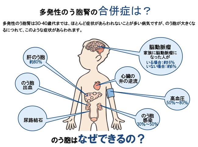 多発性のう胞腎の合併症は？