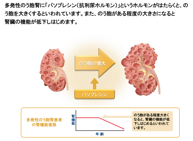 のう胞はなぜできるの？
